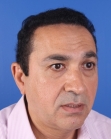 After Hair Transplant&nbsp;Front